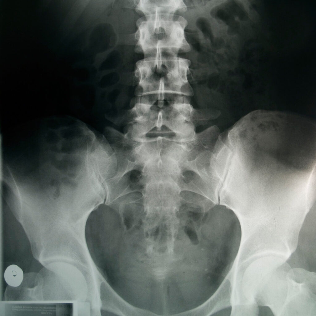 x ray of spine